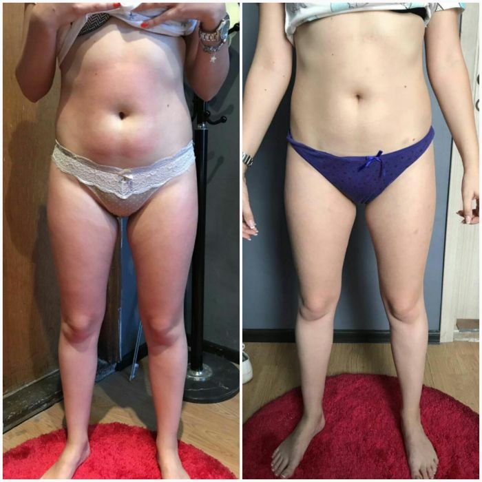 Вакумний антицелюлітний масаж