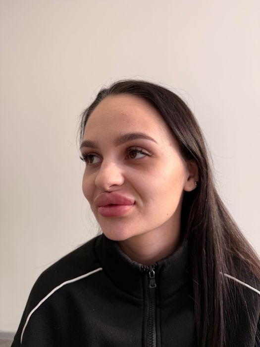 Збільшення губ. Потрібні моделі