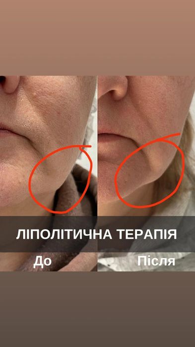 Біоревіталізація, Ботокс, Чистка шкіри, пілінги та інше
