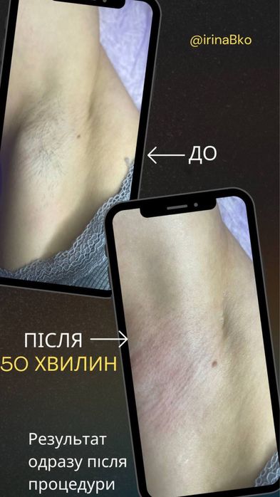 Электроэпиляция, поселок Котовского