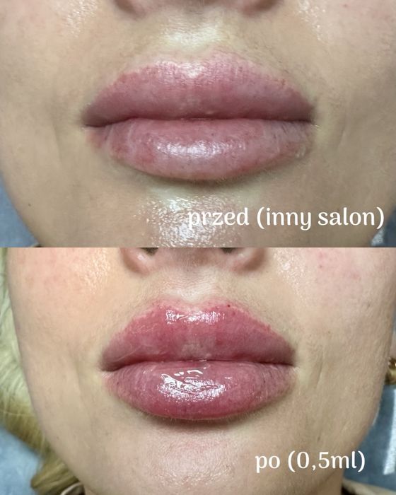 Usta na płasko, BTX, mezoterapia, lipoliza