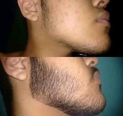 Minoxidil Extra forte -versão sem Álcool