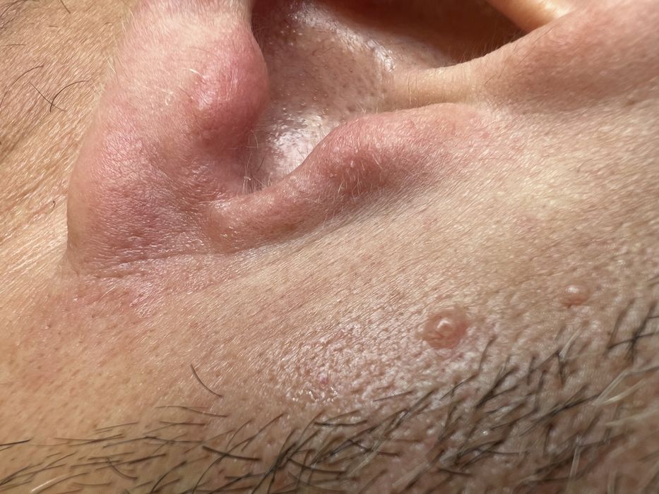 Электроэпиляция-удаление волос с гарантией результата!