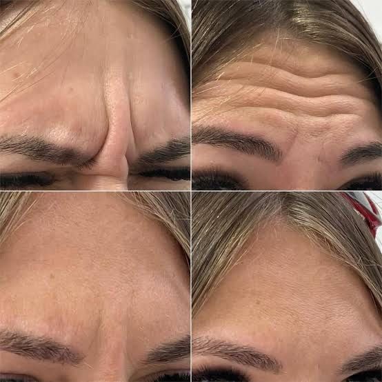 Ботокс нужны модели