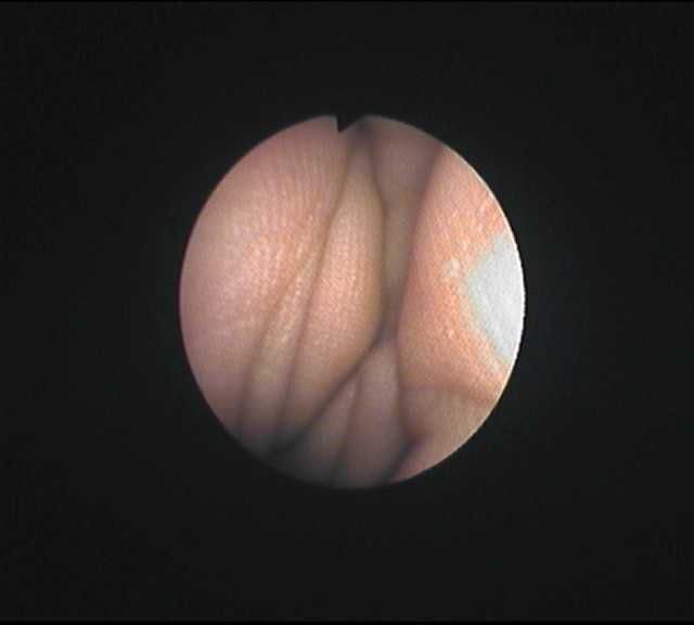 Бронхоскоп Olympus BF-P20D