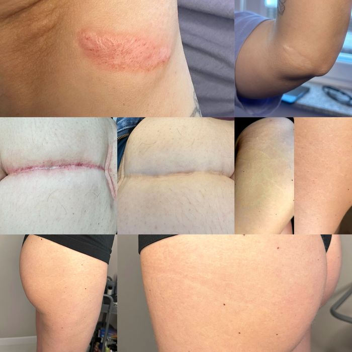 Мікронідлінг,мезотерапія обличча,рук,видалення рубців,шрамів,розтяжок