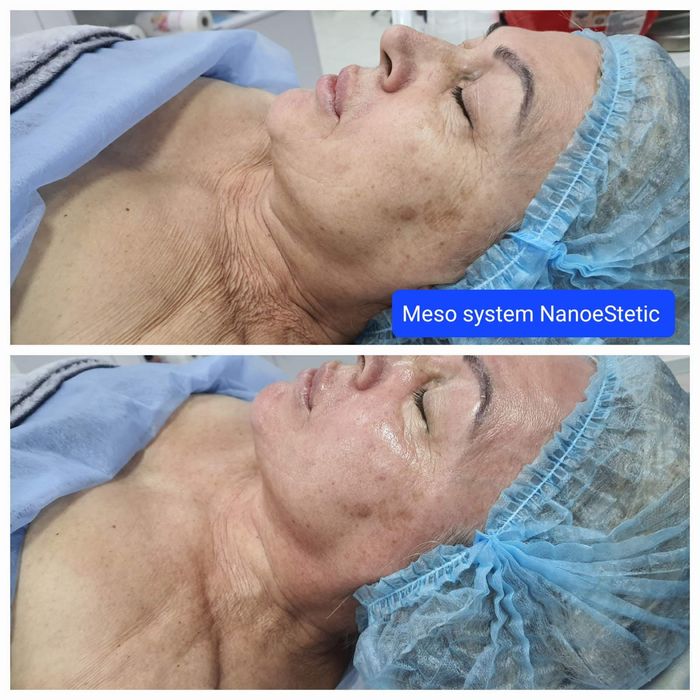 Лазерна епіляція