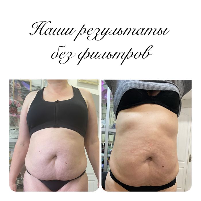 Апаратний масаж кавітація, вакум, RF ліфтінг, лазерний ліполіз