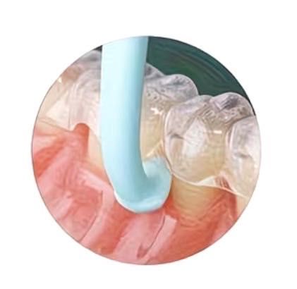 AlignEase™ – Gancho para Remover Alinhadores Invisalign + Caixa