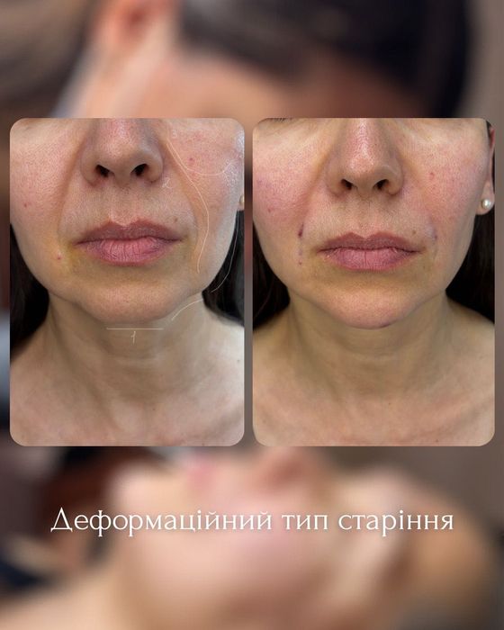 Косметолог троещина, перманент, контурная пластика, ботокс, rf лифтинг