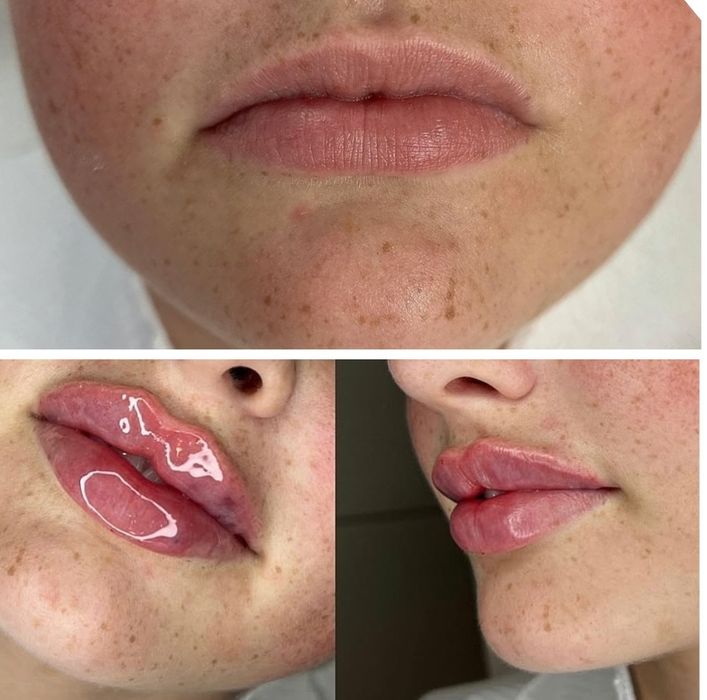 PROMOCJA powiększania ust 380zł , btx , Stymulatory