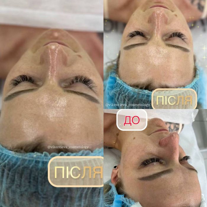 Косметолог Хмельницький | Мікронідлінг, Чистки, Догляд