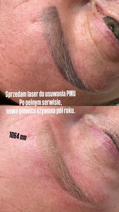 Laser Q - Switch usuwanie PMU Makijaż permanentny