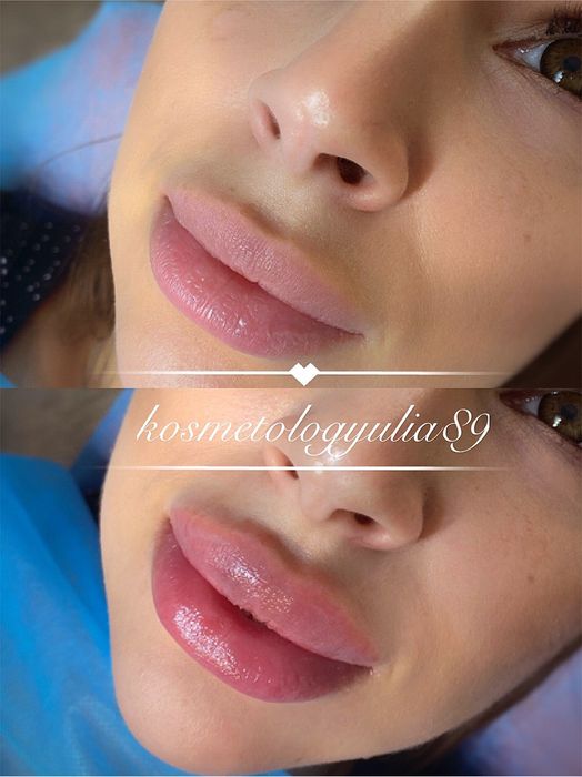 Акция! Увеличение губ Sardenya Deep от 2000 грн