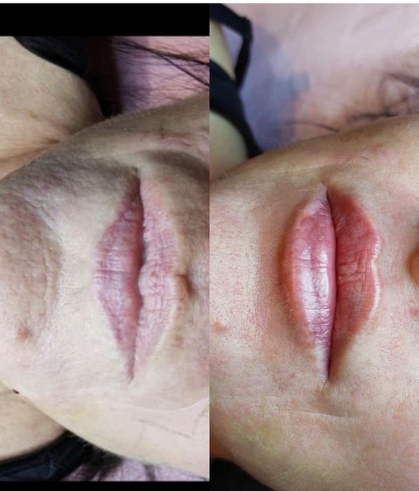 -50% BTX/ botoks/ botox/ powiększanie ust