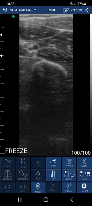 Ecografo portátil Sonostar Uprobe L5c
