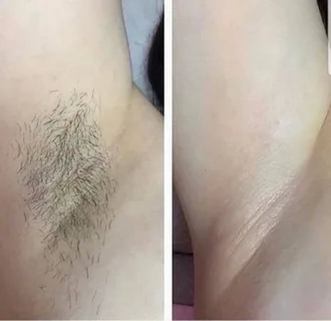 Лазерна епіляція, воскова депіляція, Геров Днепра, Оболонь