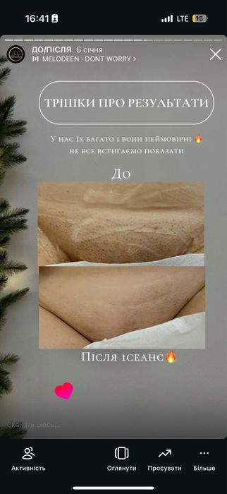 Лазерна епіляція