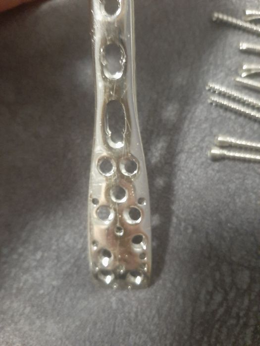 Пластина  титановая тітанова при переломе набор для остеозинтезу