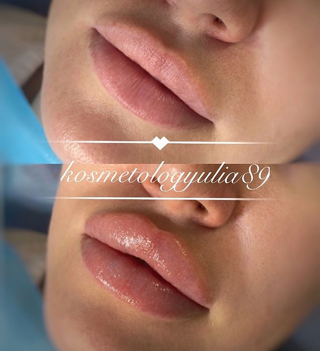 Акция! Увеличение губ Sardenya Deep от 2000 грн