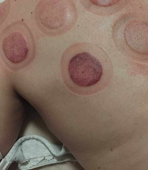 Terapia bańka ogniowa MiM Harmonia
