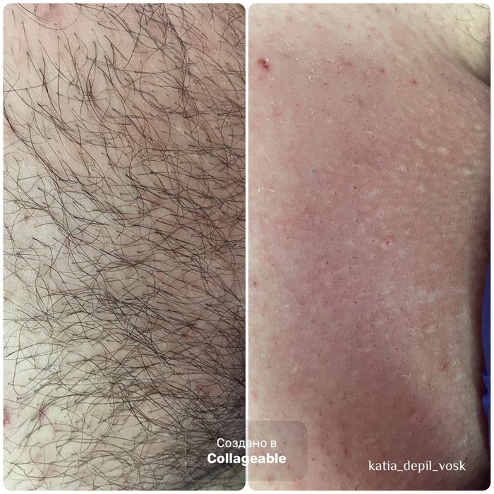 Депіляція віск Депиляция Воск Чернігів УЗ чистка обличчя