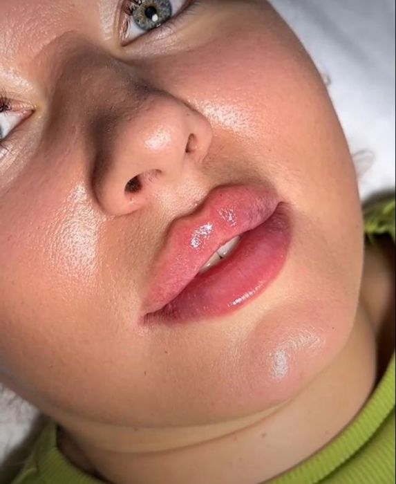 Увеличение губ ,индивидуальный подход. Сертифицированные препараты