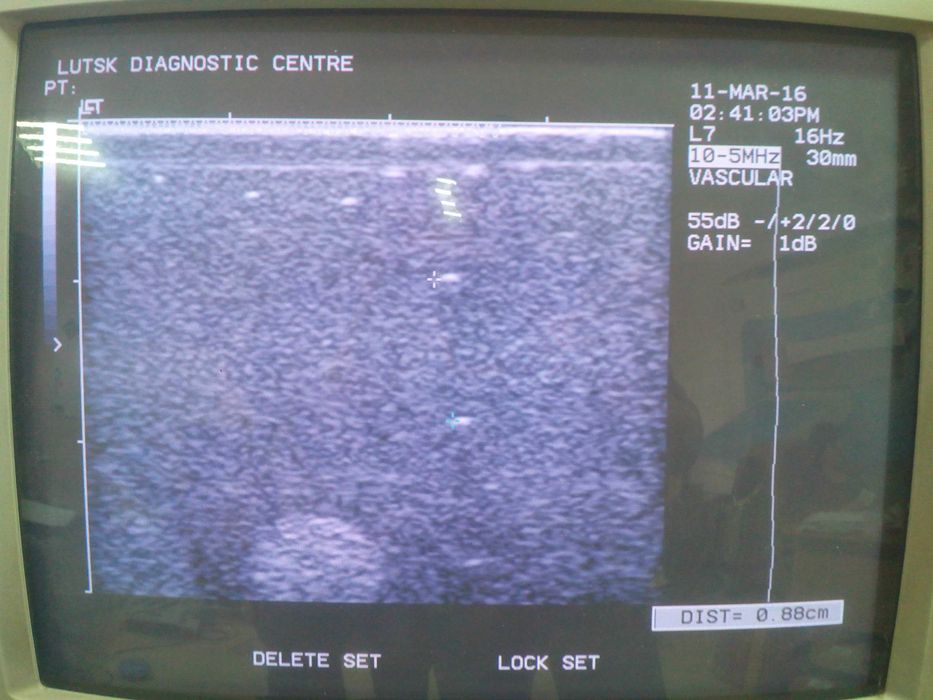 Лінійний датчик УЗД Siemens (Acuson) L7