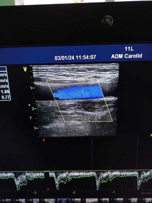 Експертна кардіосистема GE Vivid E9 (2016) M5S-D, 11L-D, 4C-D