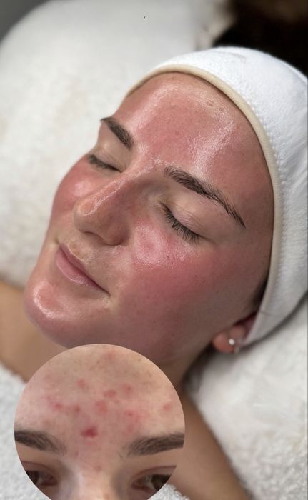 Facial Aesthetics in Lisbon | Deep Cleansing, Chemical Peels, and Microneedling