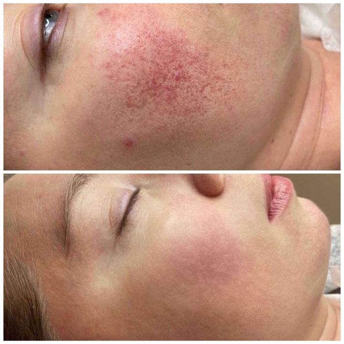 Osocze i Fibryna Kroplówki Detoks Cewnikowanie