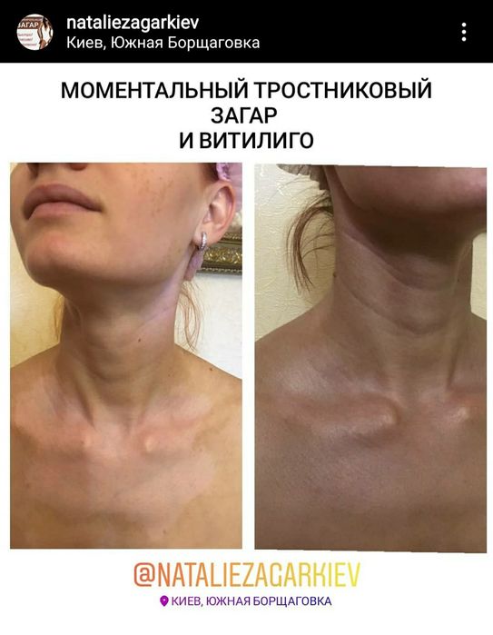 МИТТЕВА ЗАСМАГА  Київ  /  МОМЕНТАЛЬНЫЙ Тростниковый Загар в Киеве