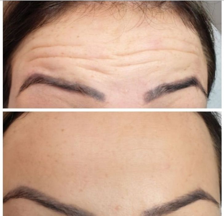 Promocja! Botox promocja 1 okolice 130zł do końca sierpnia