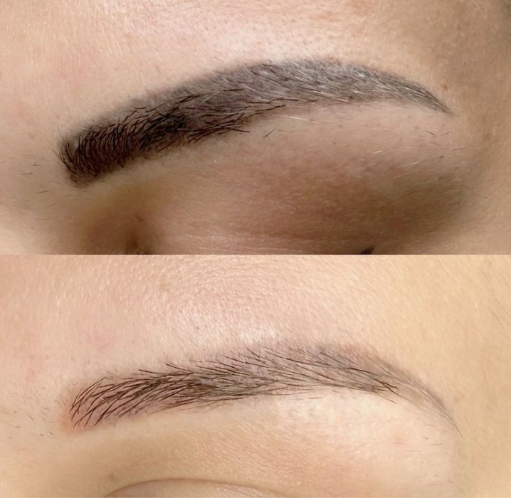 Удаление татуажа Ремувером! Качественно и эффективно!