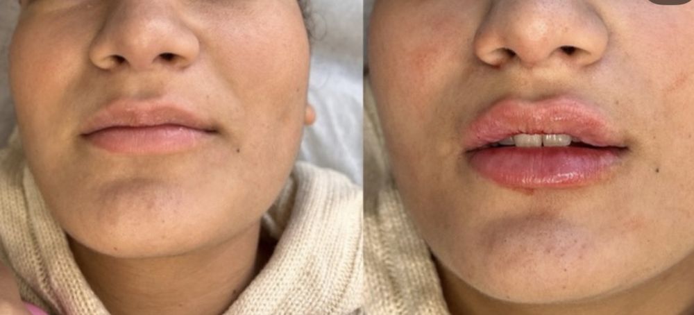 Kwas hialuronowy, botox