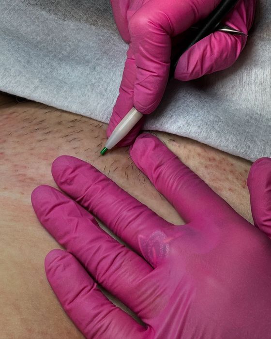 Elektroepilacja Poznań