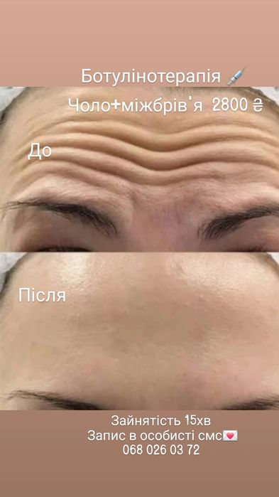 Ботулінотерапія,botox