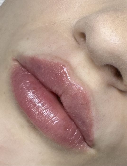 Mezoterapia efekt btx modelowanie powiekszane ust kwas hialuronowy