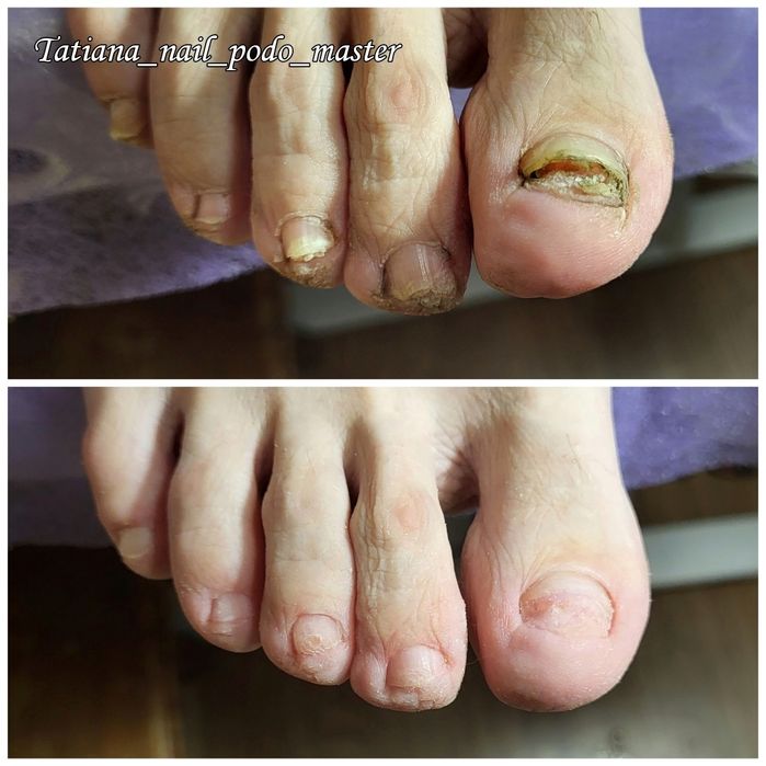 Подолог. Бородавки. Вросший ноготь. Мозоли. Грибок