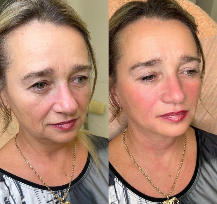 Ботокс. Контуринг. Увеличение губ. Нитевой лифтинг.Биоревитализация