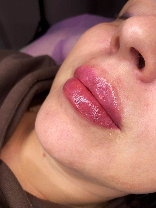 Акція! Stylage M / Контурна пластика губ /увеличение губ