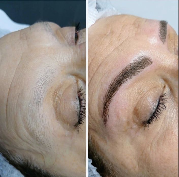Hifu, microagulhamento, Microblading,