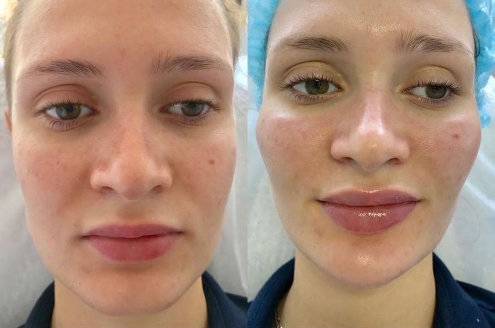 Косметолог. Губы . подбородок, углы нижней челюсти. Углы Джоли.