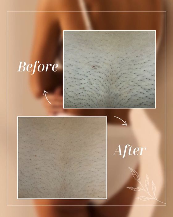 Лазерна епіляція в Запоріжжі — гладка шкіра надовго