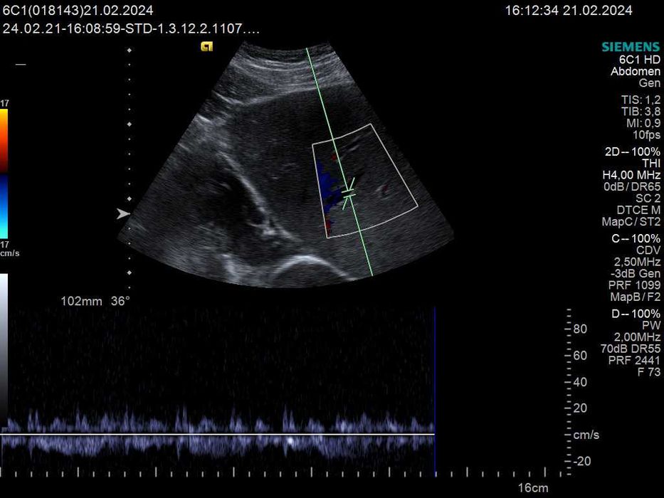 Конвексний датчик УЗД Siemens (Acuson) 6C1 HD