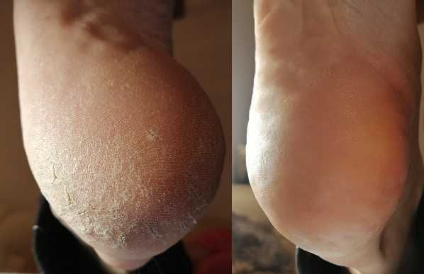 Podolog z dojazdem do domu, pedicure