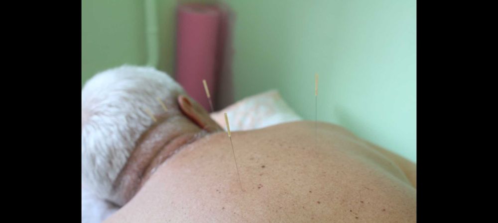 Иглотерапия. Иглоукалывание. Рефлексотерапия