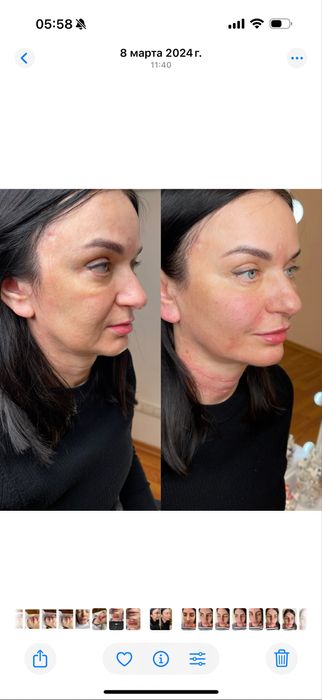 Увеличение губ.Контурная пластика.Ботокс.Биоревитализация.Липолитики.