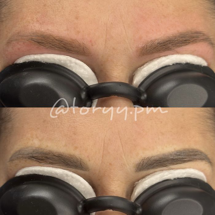 Лазерне видалення старого татуажу,перманету брів,губ,стрілок,тату