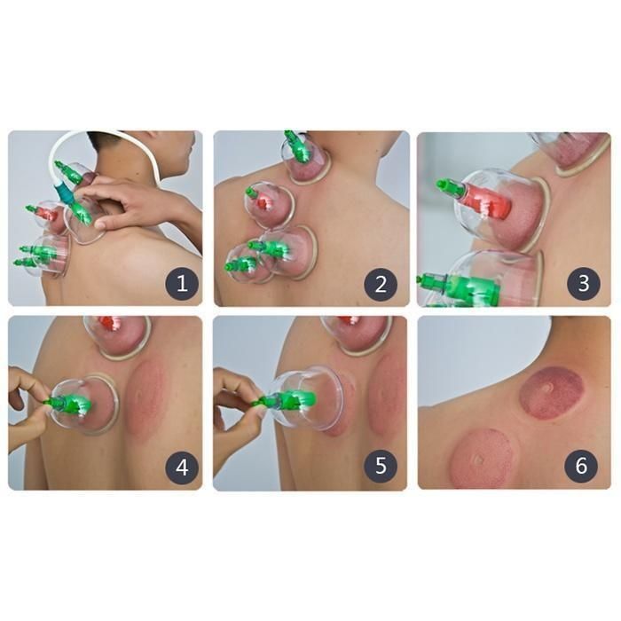 Вакуумные банки массажные с насосом - 24 шт KL